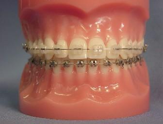 Ortodontinis gydymas- denteina.lt