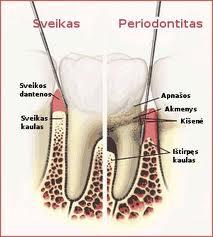periodontologinis gydymas denteina.lt