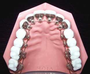 Ortodontinis gydymas breketais